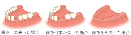 インプラント流れ (1)