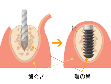 インプラント流れ (1)